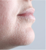 Dehydrated & Dry Skin